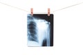 Photo of x-ray human shoulder Royalty Free Stock Photo