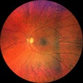 Photograph of the Fundus Oculi Royalty Free Stock Photo