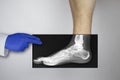 X-ray of a man`s foot. A photograph of the leg bones is applied to the patient`s feet. The radiologist examines the X-ray Royalty Free Stock Photo