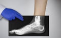 X-ray of a woman`s foot. A photograph of the leg bones is applied to the patient`s feet. The radiologist examines the X-ray Royalty Free Stock Photo
