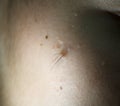 Photograph of melanoma with hairs in the facial part