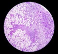 Photomicrograph of breast abscess