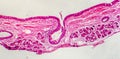 Photomicrograph of bronchial epithelial squamous metaplasia