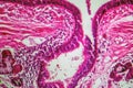 Photomicrograph of bronchial epithelial squamous metaplasia