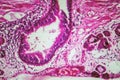 Photomicrograph of bronchial epithelial squamous metaplasia