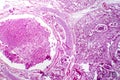 Photomicrograph of bronchopneumonia, lobular pneumonia