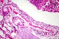 Photomicrograph of bronchopneumonia, lobular pneumonia