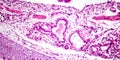 Photomicrograph of bronchopneumonia, lobular pneumonia