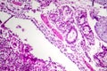 Photomicrograph of bronchopneumonia, lobular pneumonia