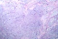 Photomicrograph of chondrosarcoma, showcasing the cellular details of this malignant cartilage tumor under the