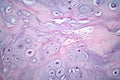 Photomicrograph of chondrosarcoma, showcasing the cellular details of this malignant cartilage tumor under the