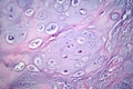 Photomicrograph of chondrosarcoma, showcasing the cellular details of this malignant cartilage tumor under the