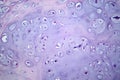 Photomicrograph of chondrosarcoma, showcasing the cellular details of this malignant cartilage tumor under the