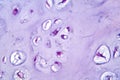 Photomicrograph of chondrosarcoma, showcasing the cellular details of this malignant cartilage tumor under the