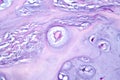 Photomicrograph of chondrosarcoma, showcasing the cellular details of this malignant cartilage tumor under the