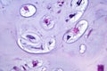 Photomicrograph of chondrosarcoma, showcasing the cellular details of this malignant cartilage tumor under the