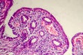 Photomicrograph of chronic cholecystitis