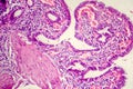 Photomicrograph of chronic cholecystitis