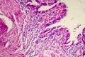 Photomicrograph of chronic cholecystitis