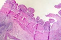 Photomicrograph of chronic cholecystitis