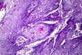 Cutaneous squamous cell carcinoma, light micrograph