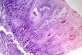 Cutaneous squamous cell carcinoma, light micrograph