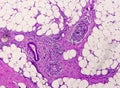 Photomicrograph of granulomatous tissue histology Royalty Free Stock Photo