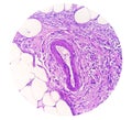 Photomicrograph of granulomatous tissue histology Royalty Free Stock Photo