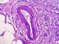 Photomicrograph of granulomatous tissue histolog Royalty Free Stock Photo