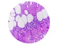 Photomicrograph of granulomatous tissue histology Royalty Free Stock Photo