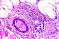 Photomicrograph of granulomatous tissue histology Royalty Free Stock Photo