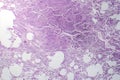 Interstitial pneumonia, light micrograph Royalty Free Stock Photo