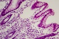 Photomicrograph of intestinal metaplasia