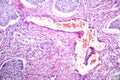 Lung adenocarcinoma, light micrograph