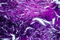 Photomicrograph of lung tissue with silicosis pathology under a microscope, revealing silica particle accumulation in alveoli and