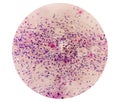 Photomicrograph of Paps Smear: Inflammatory smear with vaginal candidiasis