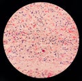 Photomicrograph of Paps Smear: Inflammatory smear with vaginal candidiasis