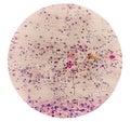 Photomicrograph of Paps Smear: Inflammatory smear with vaginal candidiasis.
