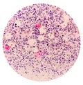 Photomicrograph of Paps Smear: Inflammatory smear with vaginal candidiasis.