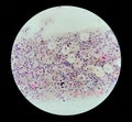 Photomicrograph of Paps Smear: Inflammatory smear with vaginal candidiasis