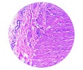 Prepatellar region histology showing Bursitis, acute or chronic Bursitis.