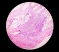 Prepatellar region histology showing Bursitis, acute or chronic Bursitis.