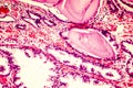 Photomicrograph of prostate hyperplasia