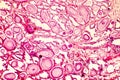 Photomicrograph of prostate hyperplasia Royalty Free Stock Photo