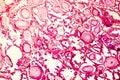 Photomicrograph of prostate hyperplasia