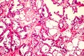 Photomicrograph of prostate hyperplasia