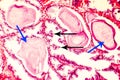 Photomicrograph of prostate hyperplasia