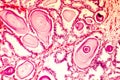 Photomicrograph of prostate hyperplasia