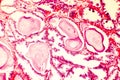 Photomicrograph of prostate hyperplasia