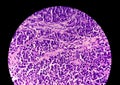 Photomicrograph of stained slide of Histology. A Slide of malignancy. Biopsy. histopathology Royalty Free Stock Photo